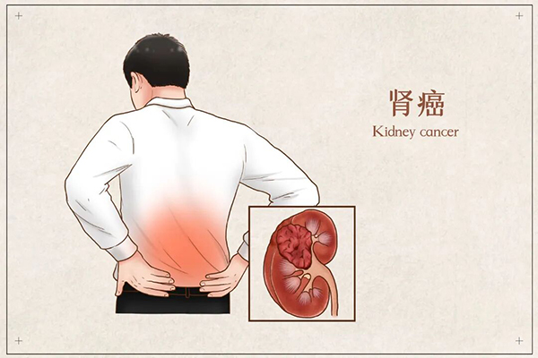 摄图网_401793821_肾癌医疗插画(非企业商用).jpg